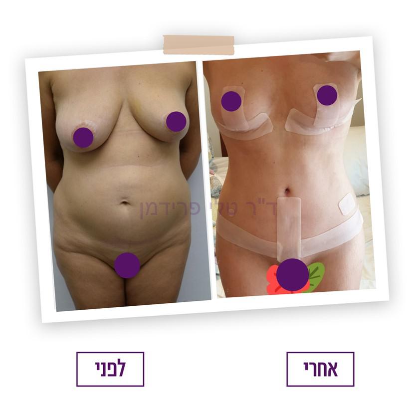 תמונה לפני ואחרי ניתוח מתיחת בטן והרמת חזה